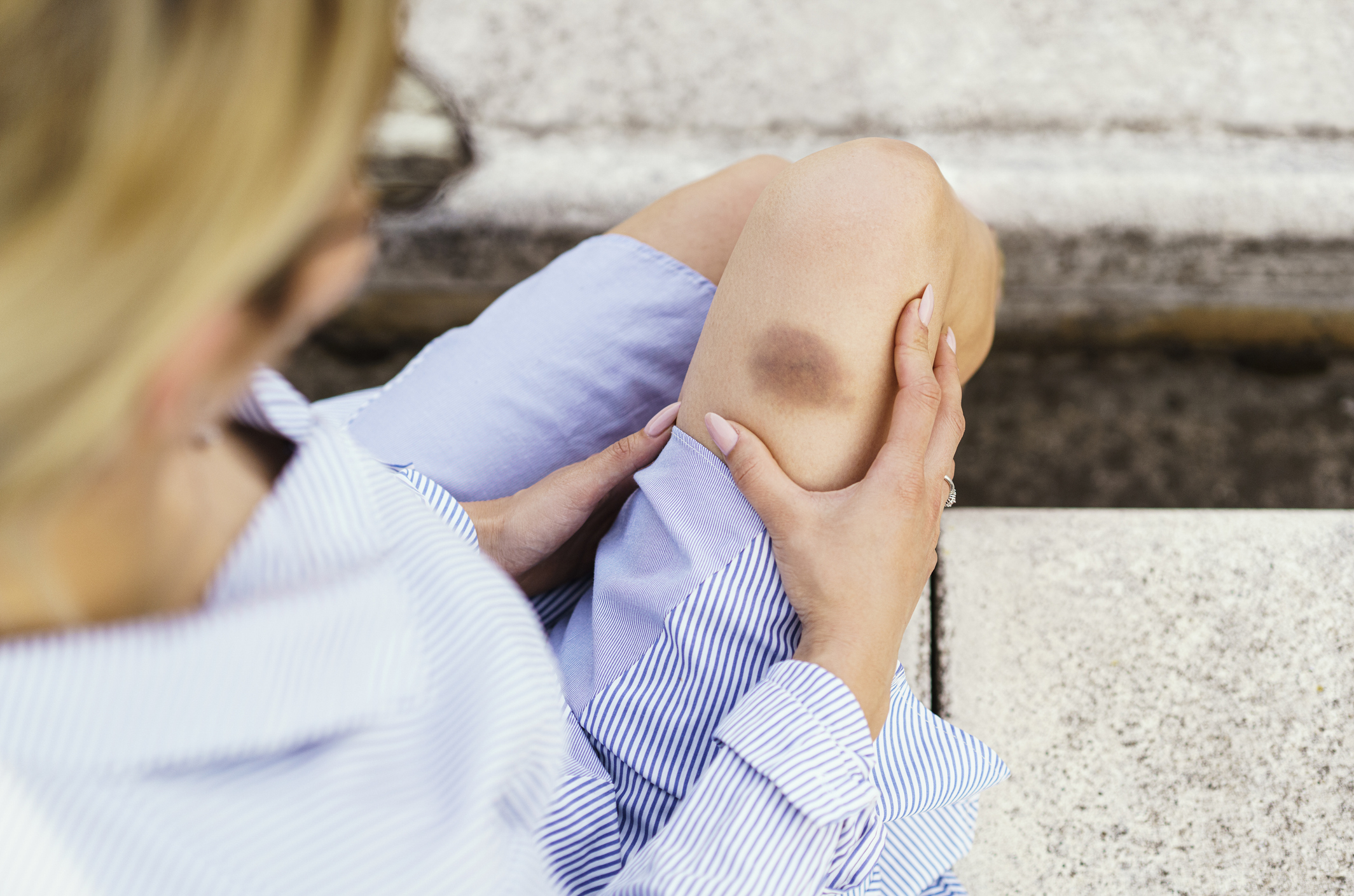 Frau sitzt auf einer Treppe und hält sich den verletzten Knien mit einem blauen Hämatom. Sie trägt ein gestreiftes Hemd und zeigt eine nachdenkliche Haltung.