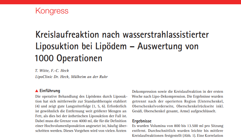 Kreisreaktion nach wasserstrahlassistierter Liposuktion bei Lipödem, Auswertung von 1000 Operationen, Kongressbeitrag zur operativen Behandlung des Lipödems, Ergebnisse zur Kreislaufreaktion und Volumina während der Behandlung.