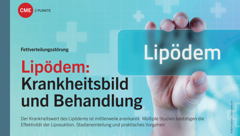 Bild mit dem Titel Lipödem: Krankheitsbild und Behandlung, das Informationen über die Fettverteilungsstörung Lipödem liefert. Der Text betont die Anerkennung des Krankheitswerts sowie die Wirksamkeit der Liposuktion und behandelt die Stadieneinteilung und das praktische Vorgehen.